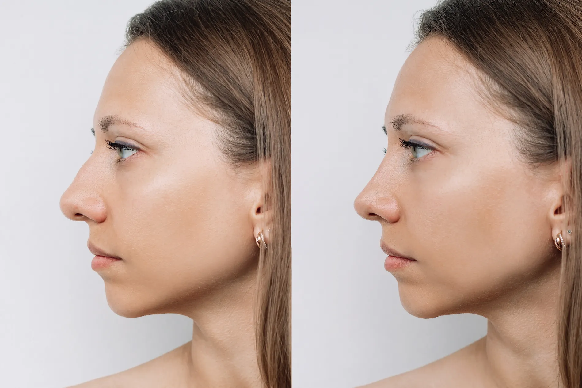 profile-woman-face-with-nose-before-after-rhinoplasty