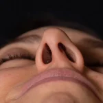 Septoplasti nasıl görünür